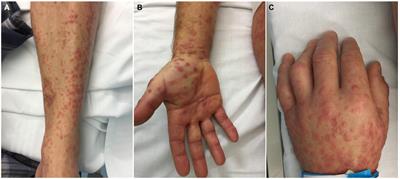 Atypical exanthem with acral involvement in adult patients associated with human herpesvirus 7 active replication: A case series